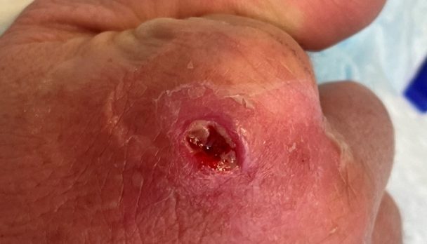 46 year old man and Abscess Cavity