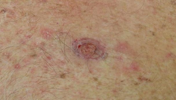 Feb 2025 - chest SCC