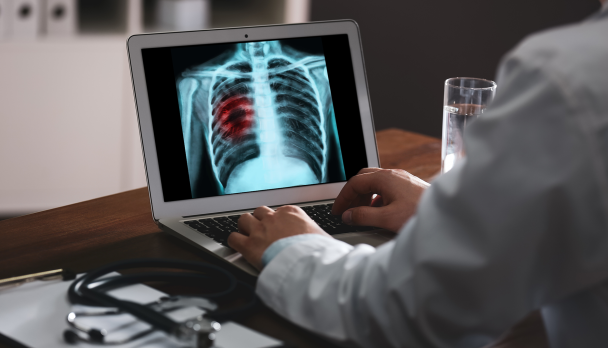 Lung-cancer-screening