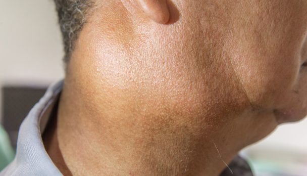 Zooming,Closeup,Lateral,View,Of,Enlarged,Lymph,Nodes,And,Submandibular